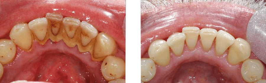 Zubni kamenac 