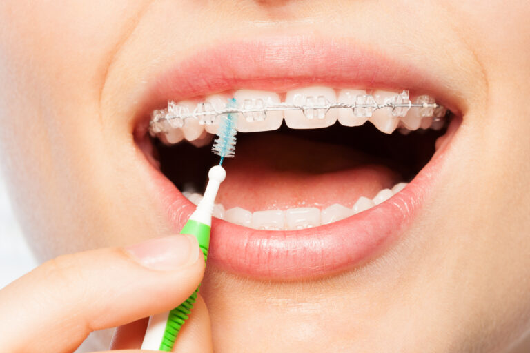 Čišćenje zubi interdentalnom četkicom